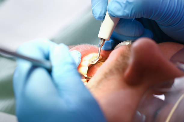 Best Broken or Chipped Tooth Repair in Eslon, CA